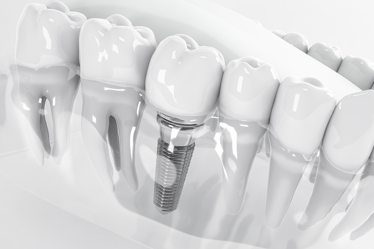 Üsküdar İmplant Tedavisi Dentalzone