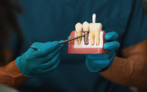 Üsküdar İmplant Tedavisi Dentalzone