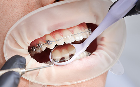 Üsküdar Ortodonti Tedavisi - Dentalzone