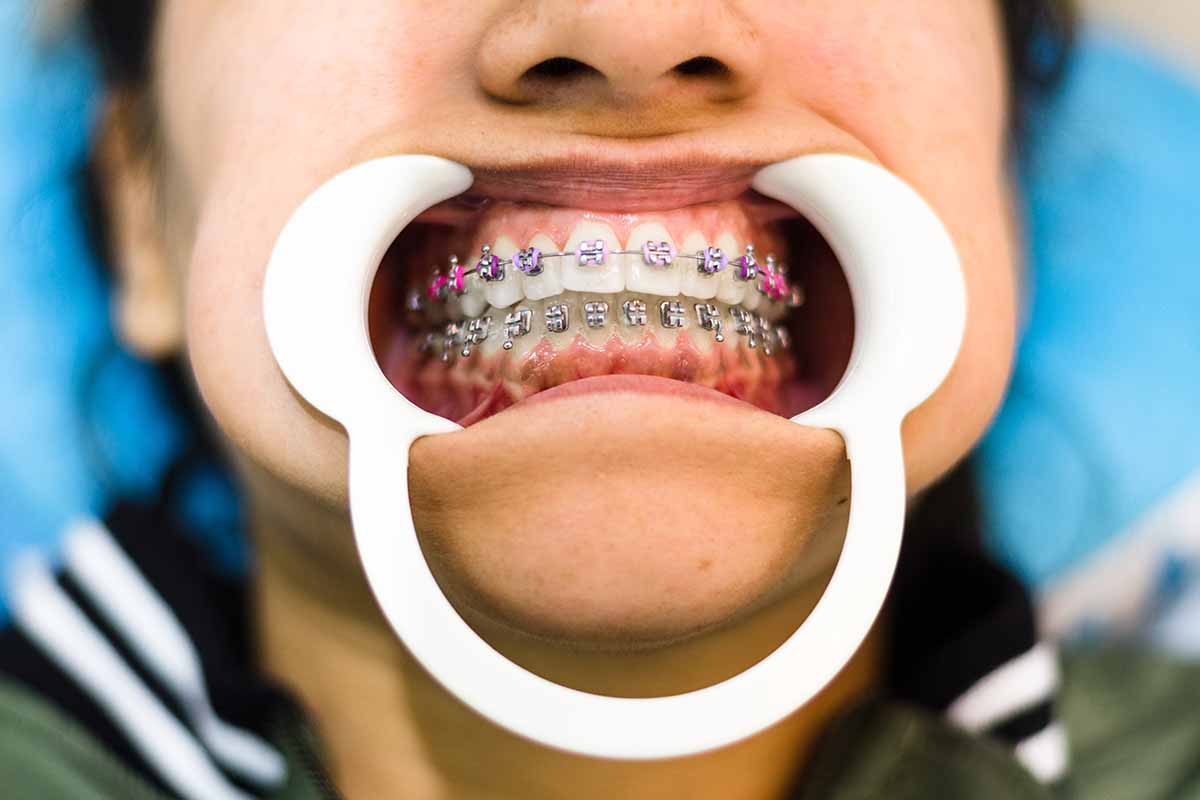 Üsküdar Lingual Ortodonti Tedavisi - Dentalzone Diş Kliniği