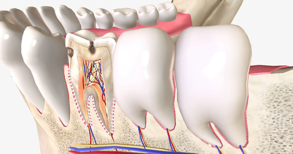 Diş ve diş eti arasındaki periodontal cebi ve diş eti yapısını gösteren medikal illüstrasyon